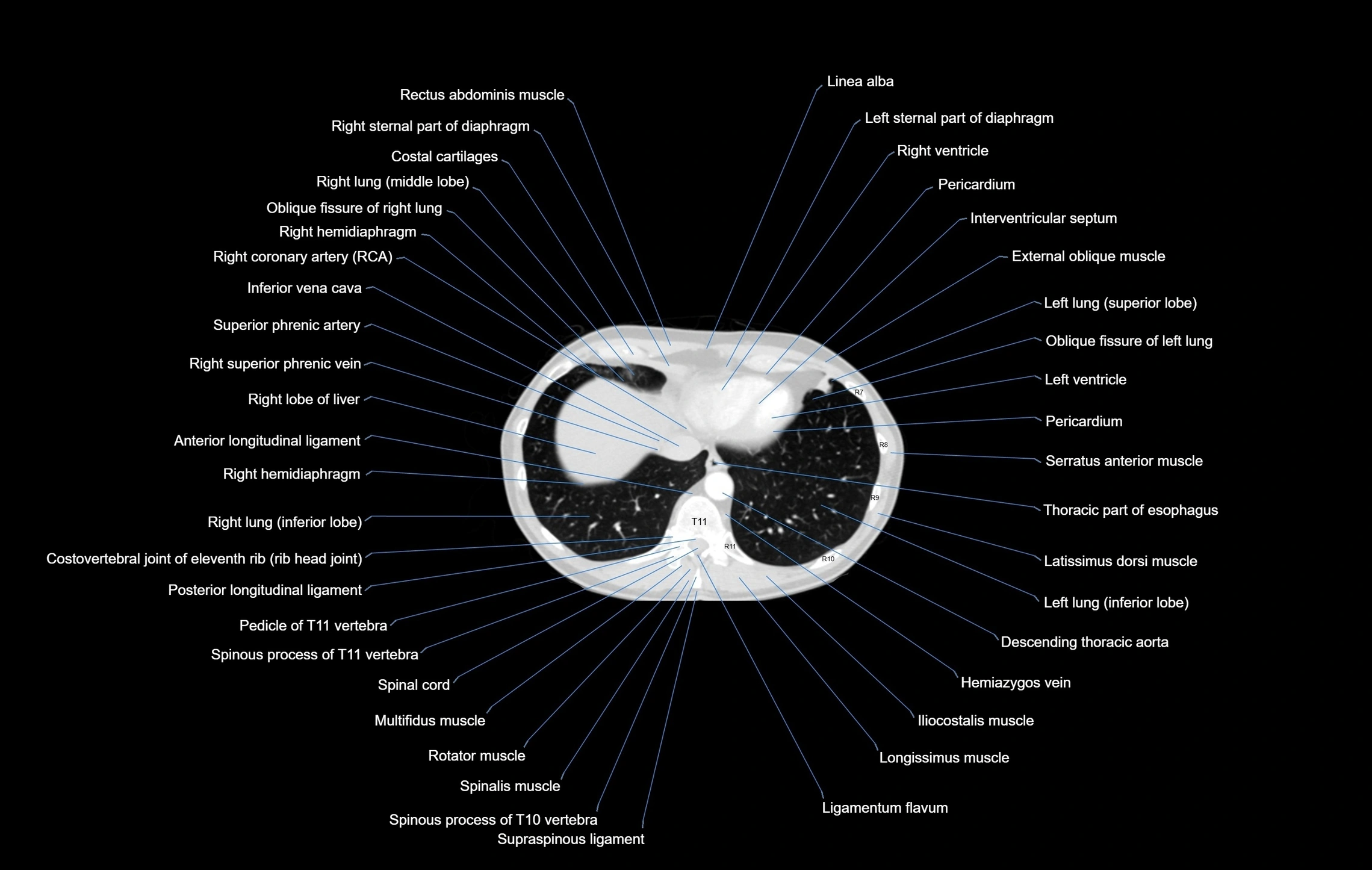 CT chest (thorax) labelled axial cross sectional anatomy radiology image-00097.webp